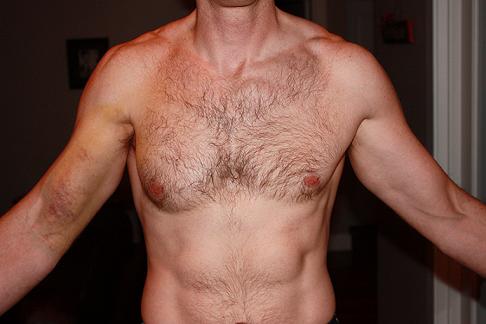 pec tear 1.jpg